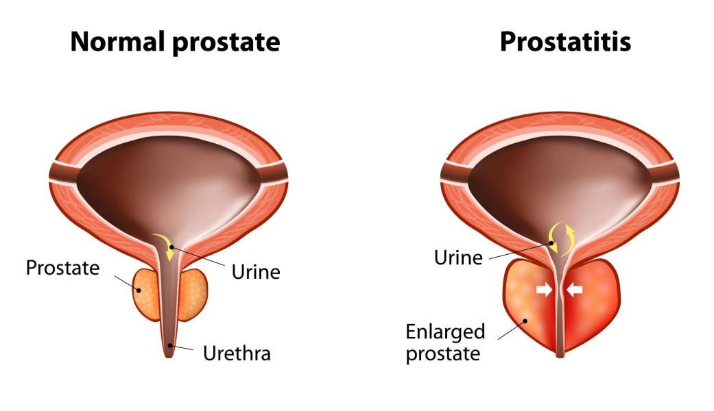 Imagem com uma próstata norma e uma próstrata com prostratite