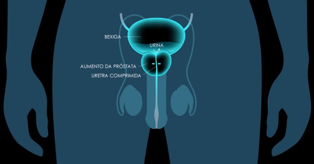 Como diminuir a próstata aumentada? A próstata tem duas fases principais de crescimento na vida dos homens: a primeira ocorre na puberdade, quando dobra de tamanho, e a segunda é a partir dos 25 anos, depois que o tamanho normal da próstata atinge as dimensões de uma noz. Quando a próstata fica aumentada, os desconfortos são inúmeros, porque comprime a uretra, o que atinge em cheio o comportamento miccional do homem, podendo levá-lo até a um isolamento social por constrangimento diante dos sintomas, porque é comum: Ter a frequência miccional muito aumentada, mais de 8 vezes ao dia; Dor ao urinar ou ejacular; Sentir o jato urinário fraco; Gotejamento ao final da micção Não conseguir esvaziar completamente a urina; Sofrer de incontinência urinária, etc. Por isso, como diminuir a próstata é uma pergunta que precisa de respostas bem objetivas e, de preferência, com tratamentos rápidos. Existem diversos tratamentos que podem ajudar os homens nesta questão, podem ser desde mudanças no estilo de vida a abordagens medicamentosas e até cirúrgicas.