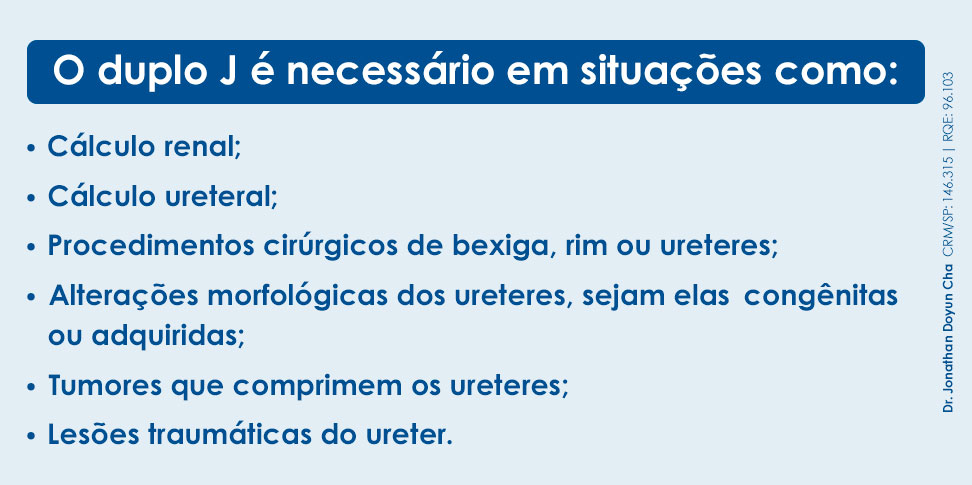 Em quais situações o duplo J é necessário? Em toda situação que há um risco de interrupção do fluxo urinário adequado entre o rim e a bexiga, o cateter pode ser necessário. Aliás, como já mencionado, sua utilização mais frequente é após a retirada de pedras nos rins ou ureteres. No entanto, existem outras circunstâncias onde o duplo J pode ser aplicado. As principais são: Cálculo renal; Cálculo ureteral; Procedimentos cirúrgicos de bexiga, rim ou ureteres; Alterações morfológicas dos ureteres, sejam elas congênitas ou adquiridas; Tumores que comprimem os ureteres; Lesões traumáticas do ureter.