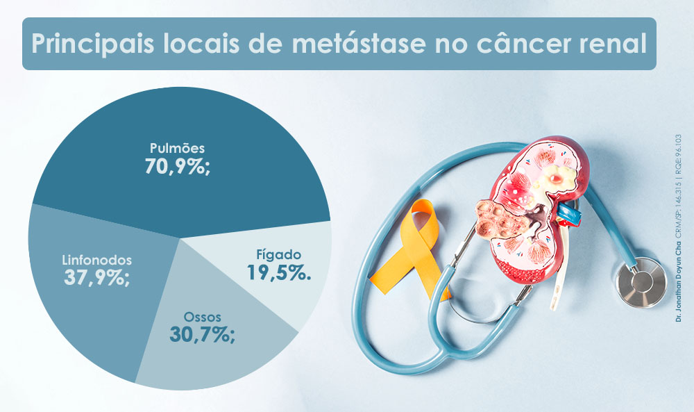 Principais locais de metástase no câncer renal
