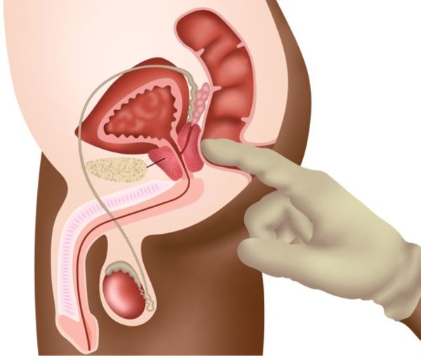 imagem câncer de próstata afeta o intestino
